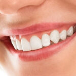 How a Smile Makeover Can Refresh Your Overall Look