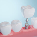 Benefits of Dental Implants: Multiple Tooth Replacement
