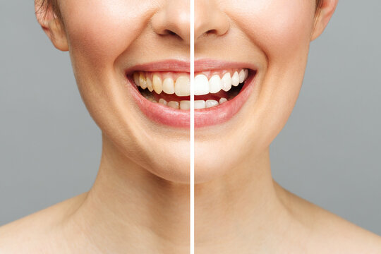 Common Causes of Tooth Stains and How Teeth Whitening Can Help
