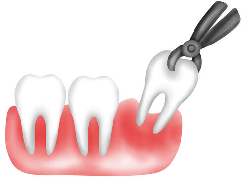 What to Expect Before and After Wisdom Tooth Removal in Nashik