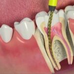 Is Root Canal Treatment Safe for Kids? A Pediatric Dentist Explains