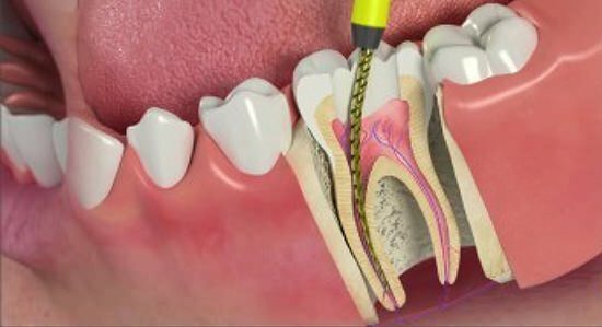 Is Root Canal Treatment Safe for Kids? A Pediatric Dentist Explains