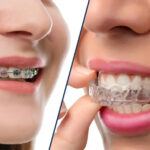 Invisalign vs Braces for Crowded Teeth: Which Treatment Works Best?