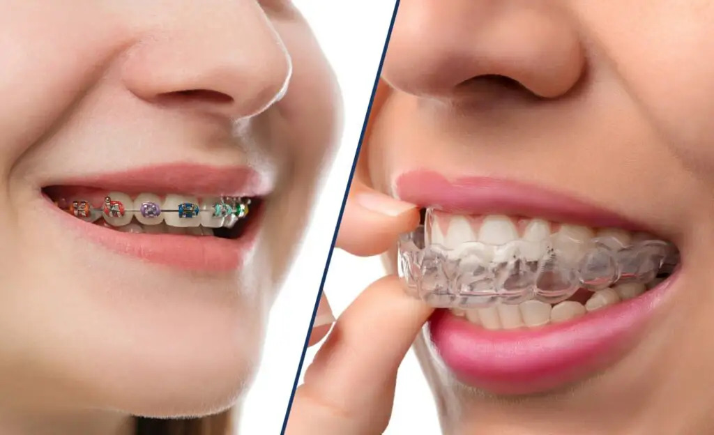 Invisalign vs Braces for Crowded Teeth: Which Treatment Works Best?