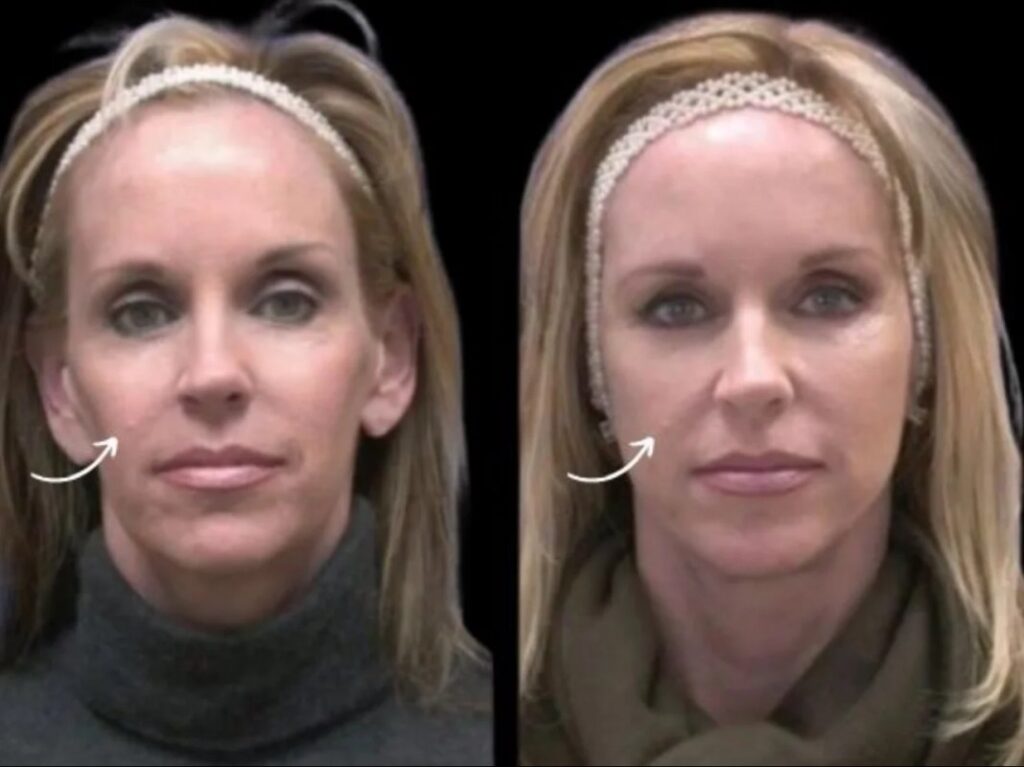 Sculptra Skin Transformation by Best Doctors in Dubai