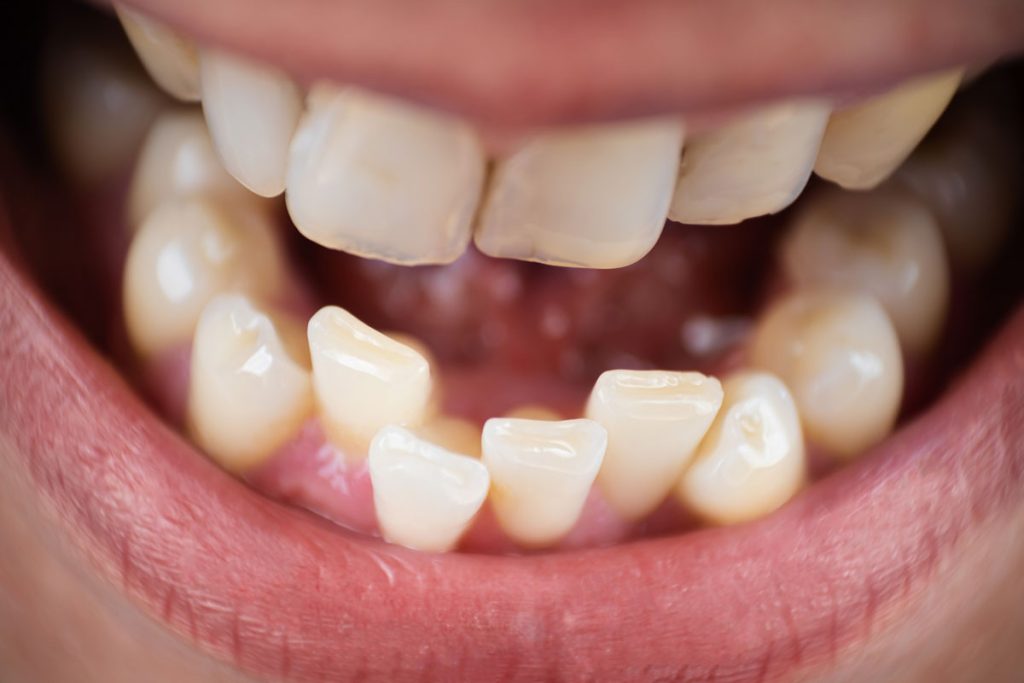 Why Do I Have Crooked Teeth? Causes and Treatment Options
