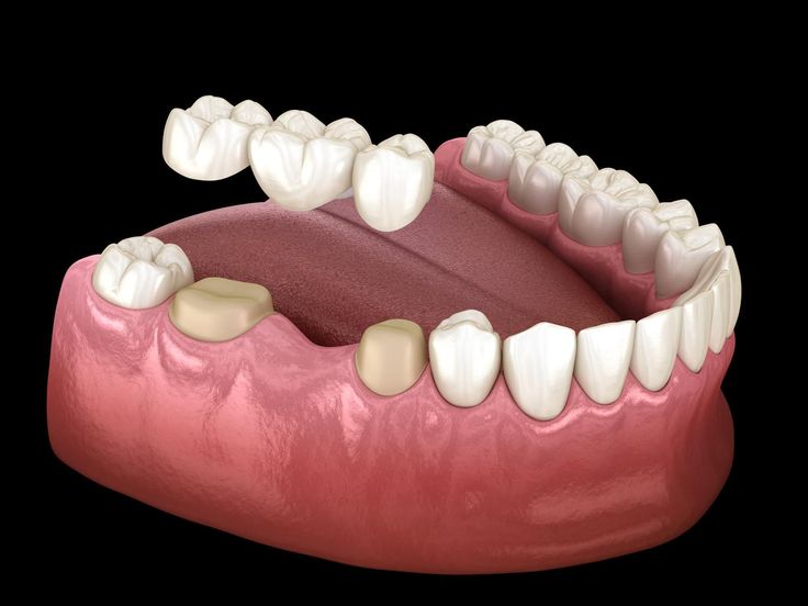 Affordable Dental Crown Cost in Bilaspur – What You Should Know Before Treatment
