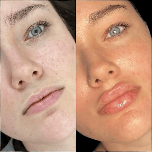 Best Doctors in Dubai for Fillers for Elegant Facial Contours