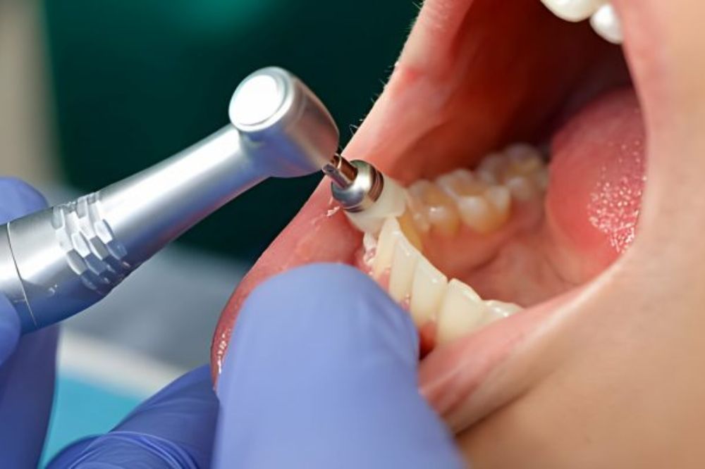 Professional Teeth Cleaning: How Often Do You Really Need It?