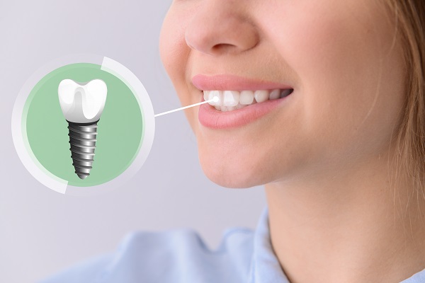 What to Expect During the Tooth Implant Journey: A Step-by-Step Guide