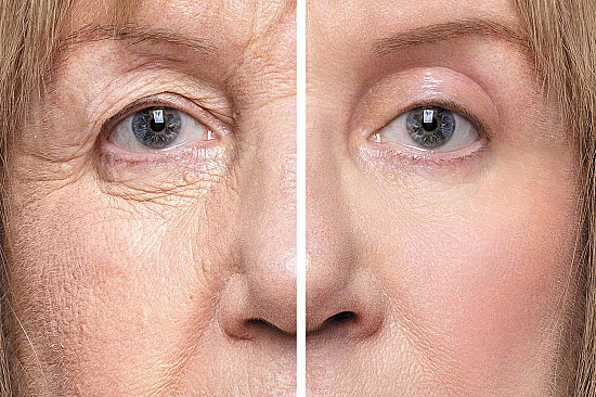 Best Ptosis Singapore Treatment for Droopy Eyelids | Expert Eye Correction