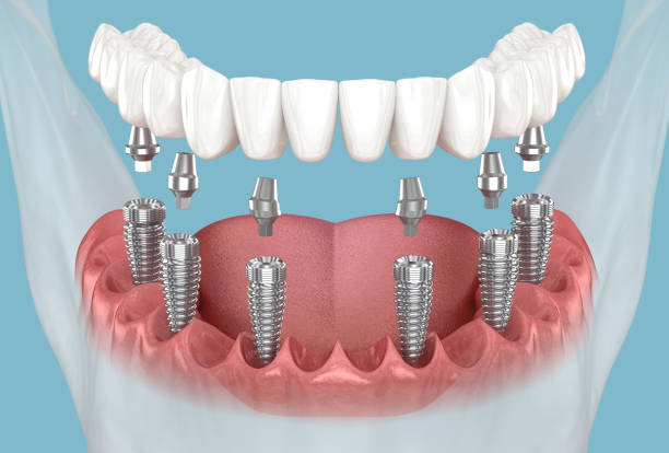 Dental Implants: A Comprehensive Cost-Benefit Analysis for Your Smile