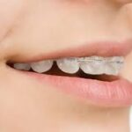 Braces Treatment: A Personalized Approach to Teeth Alignment