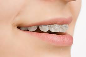 Braces Treatment: A Personalized Approach to Teeth Alignment