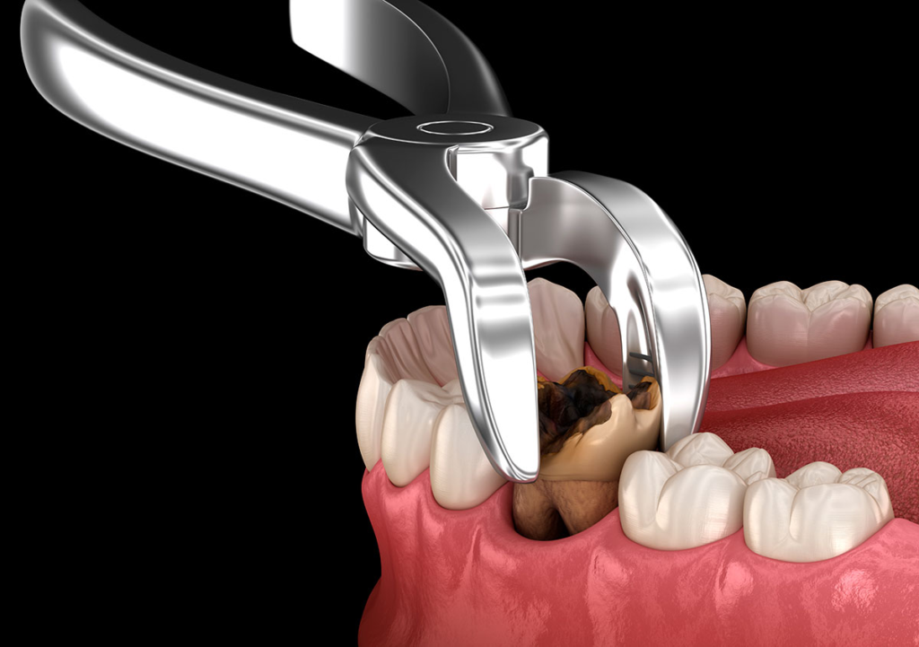 Tooth Extraction: What To Expect Before And After 2026