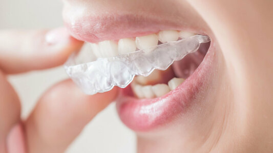 Invisalign: What To Expect And How To Make It Work For You