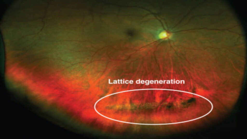 Lattice Retinal Degeneration: Key Facts Every Patient Needs