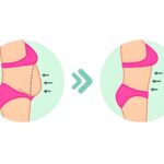 Is a Tummy Tuck Right for You? A Complete Guide to Abdominoplasty Candidates