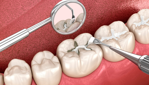 Why Tooth-Colored Fillings Are the New Standard in Panvel’s Modern Dental Care