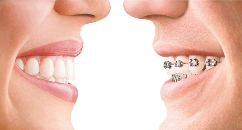 Invisible vs Traditional Braces Treatment: Which Is Better?