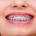 Achieving A Beautiful Smile With Braces: Your Guide To Orthodontic Care