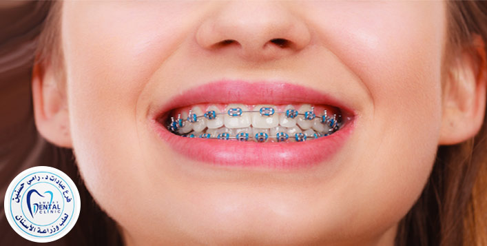 Achieving A Beautiful Smile With Braces: Your Guide To Orthodontic Care