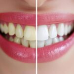 Is Teeth Whitening Worth the Cost? Benefits, Results, and Value Explained