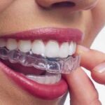 How Much Does Invisalign Cost? Everything You Need to Know About Invisalign Cost