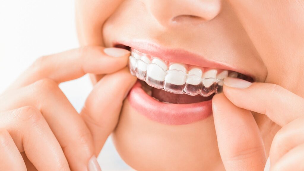 Why Modern Professionals are Choosing Clear Aligner in Parel for Smile Correction