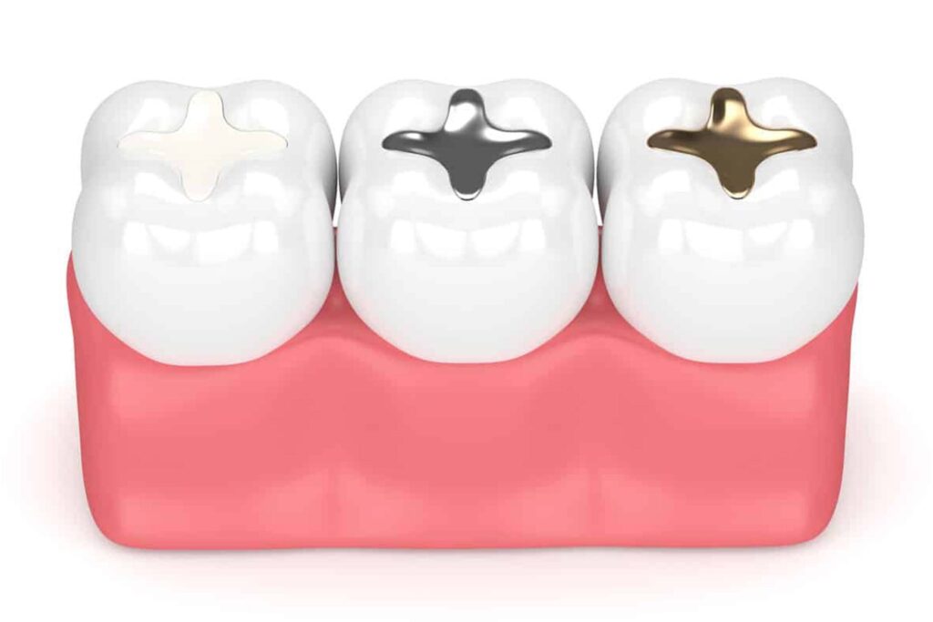 Tooth-Colored Fillings: A Modern Solution for Natural Smile Restoration