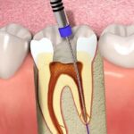 Gentle Dentistry: How Root Canal Treatment for Kids Is Made Pain-Free