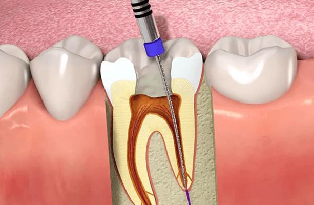Gentle Dentistry: How Root Canal Treatment for Kids Is Made Pain-Free