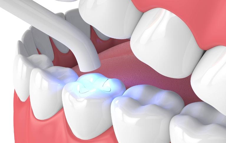 Are Tooth Colored Fillings Worth the Cost? Everything You Need to Know