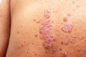 Chronic Skin Disorders and The Role of the Immune System in them