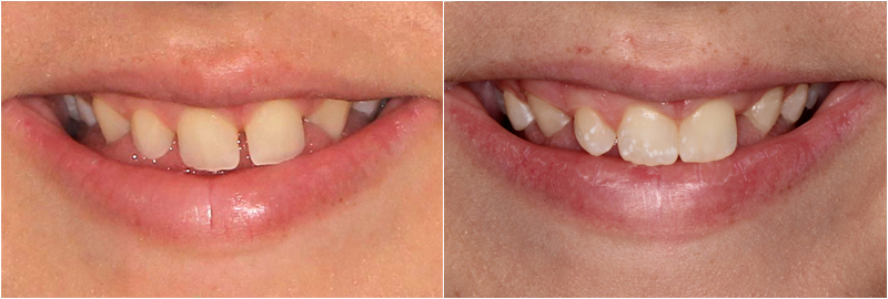 Why More Adults Are Choosing Invisalign