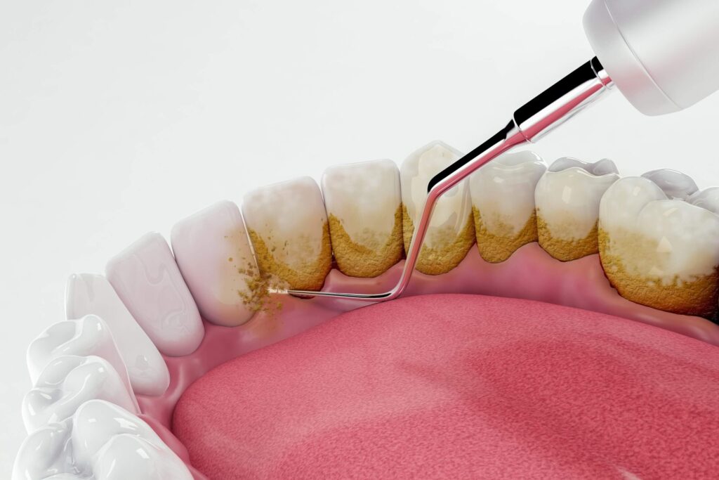 How Teeth Cleaning Helps Prevent Cavities and Gum Disease