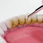 How Teeth Cleaning Helps Prevent Cavities and Gum Disease