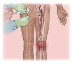 Genicular Artery Embolization: A Modern Solution for Knee Pain Relief Without Surgery