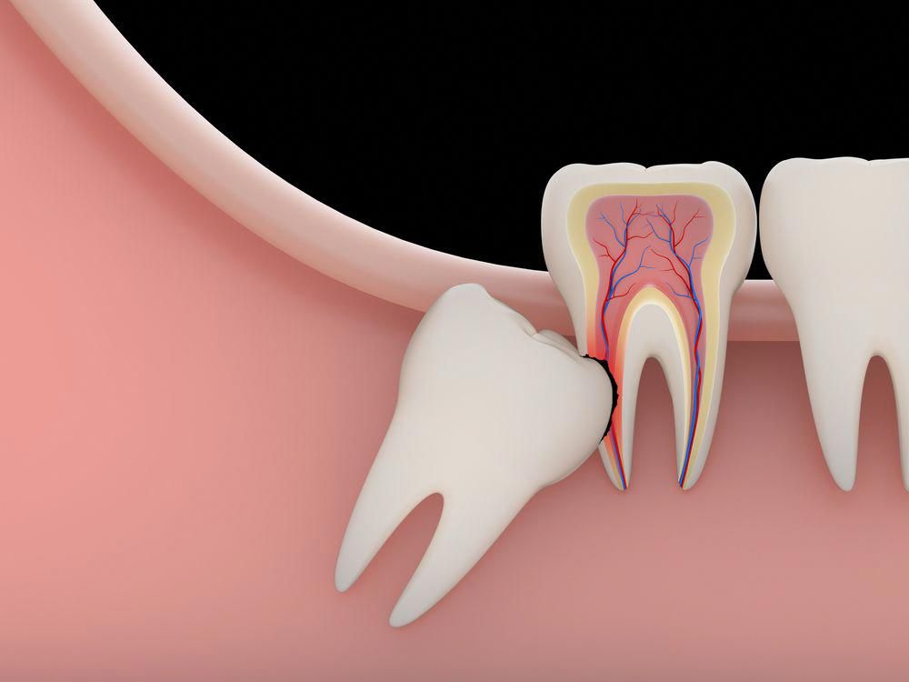 Struggling with Wisdom Tooth Pain in Bilaspur? Here’s the Right Solution
