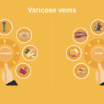 Varicocele: Causes, Symptoms & Best Treatment Options