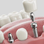 Why Dental Implants Fail and How to Ensure Long-Term Success
