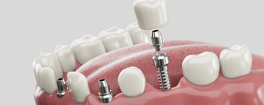 Why Dental Implants Fail and How to Ensure Long-Term Success
