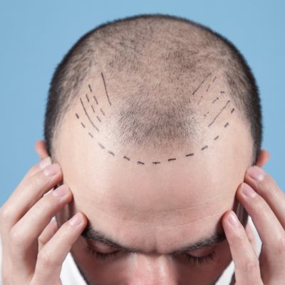 Why Hair Transplant Is the Most Effective Solution for Hair Loss Today