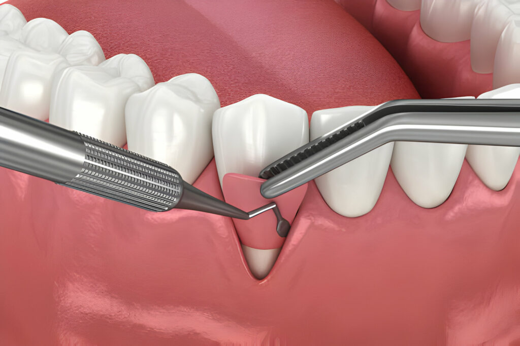 Gum Surgery: Critical Red Flags You Should Never Ignore