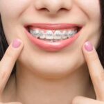 What to Eat and Avoid During Braces Treatment: A Complete Guide