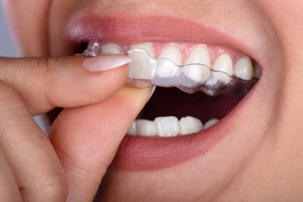 Clear Aligner Cost in Hinjewadi: What’s Included in the Treatment Price?
