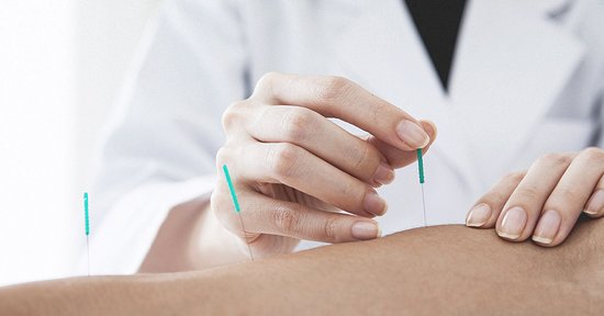 What Is Dry Needling Therapy? Benefits, Process, and How It Works