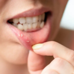 The Hidden Triggers of Recurrent Mouth Ulcers and How to Find Lasting Relief