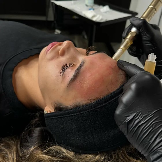 How Microneedling Works in Houston Clinics: Full Guide