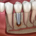 Why Dental Implants Are The Perfect Solution For Missing Teeth